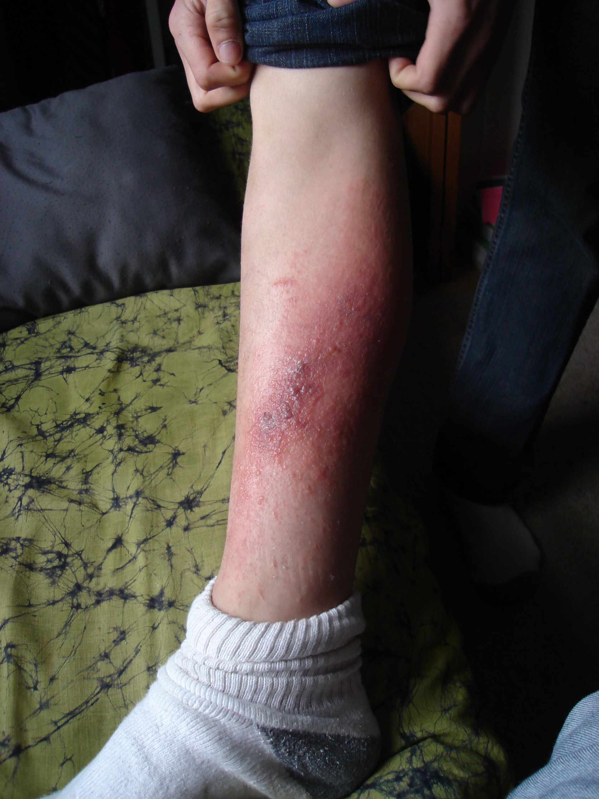 A poison ivy rash with red, irritated skin showing how contact dermatitis can appear after urushiol exposure.