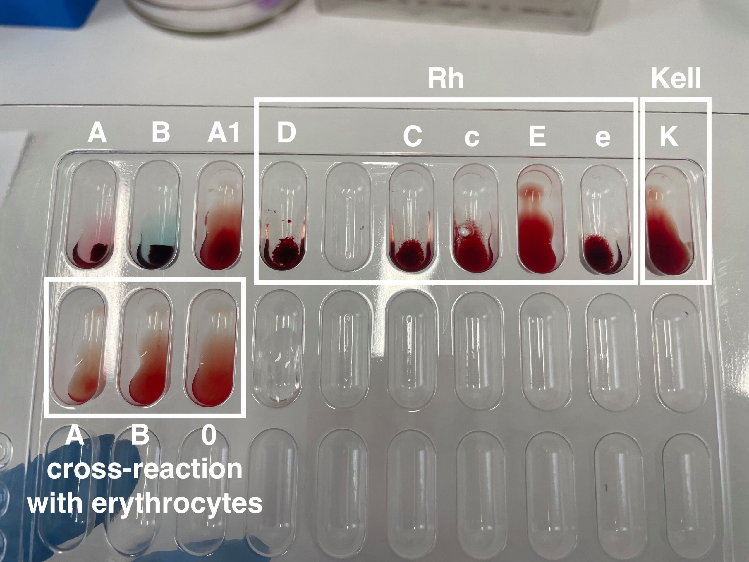 A clinical blood typing card showing visible agglutination reactions used to identify ABO and Rh markers.